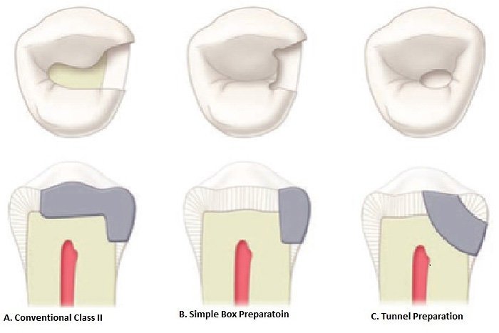 Box preparation in cavity preparation.
