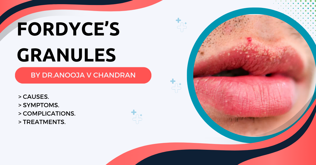 FORDYCE’S GRANULES Causes, Symptoms, Treatments