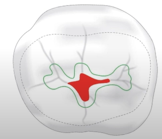 Inclusion of weakend structure in cavity preparation.