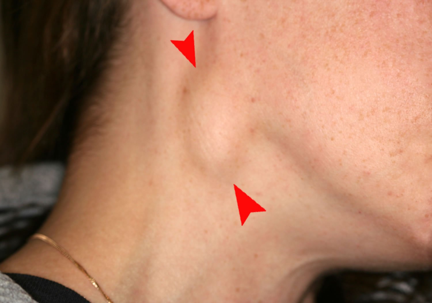 Lymphadenopathy in ANUG