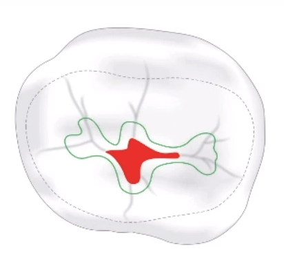 Outline form in cavity preparation