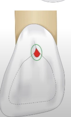Principles of cavity preparation