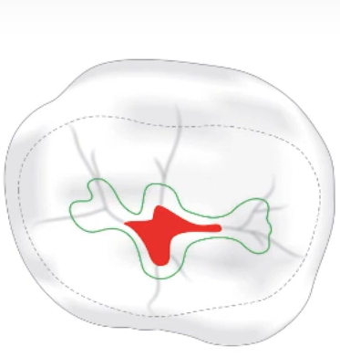 Principles of cavity preparation