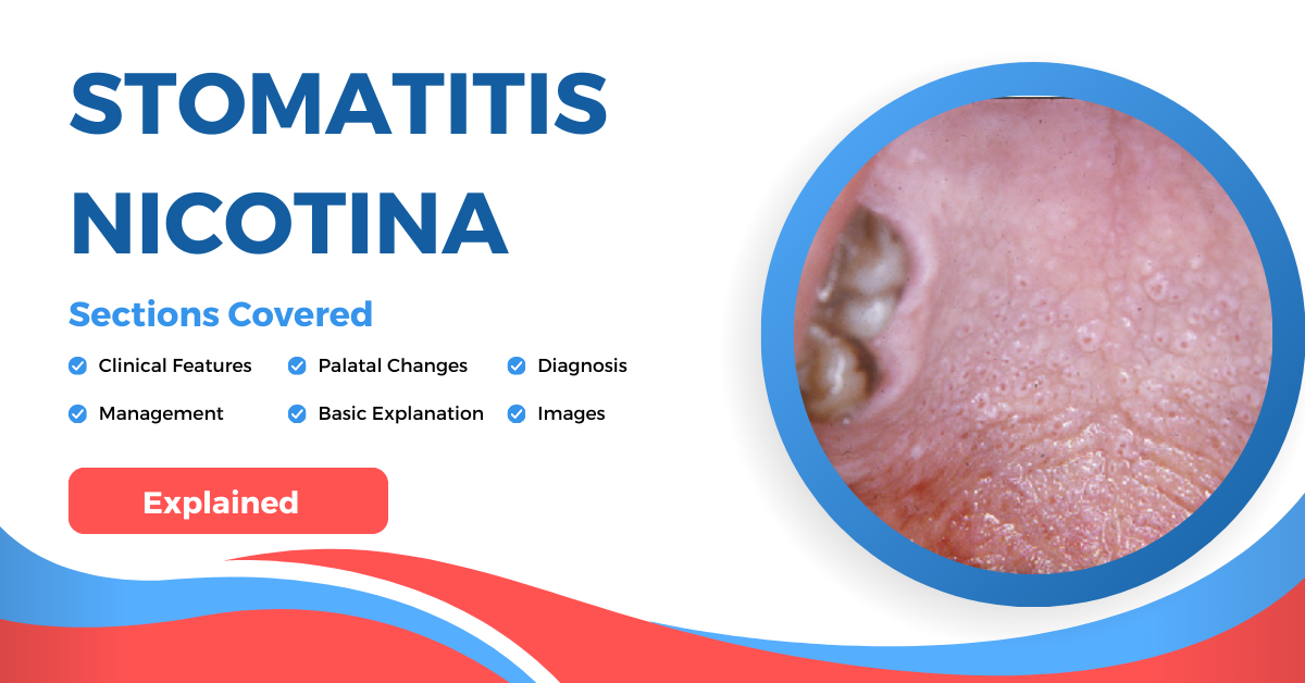 Stomatitis Nicotina explanation and notes