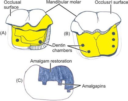 Amalgapins in cavity preparation.