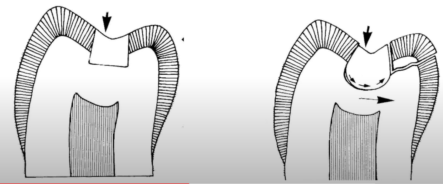 Box shape preparation to prevent microleakage.