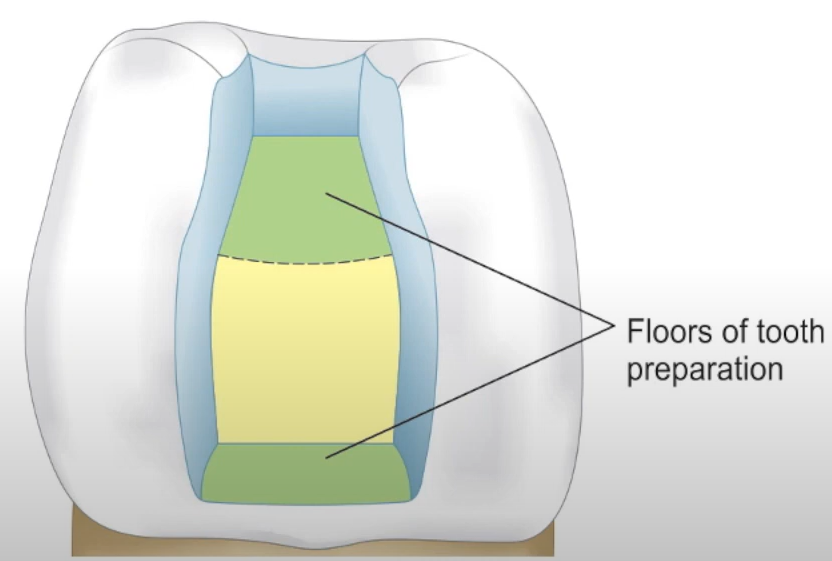 Box shape preparation.