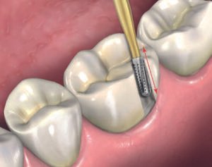 Buccal surface in GV Black classification