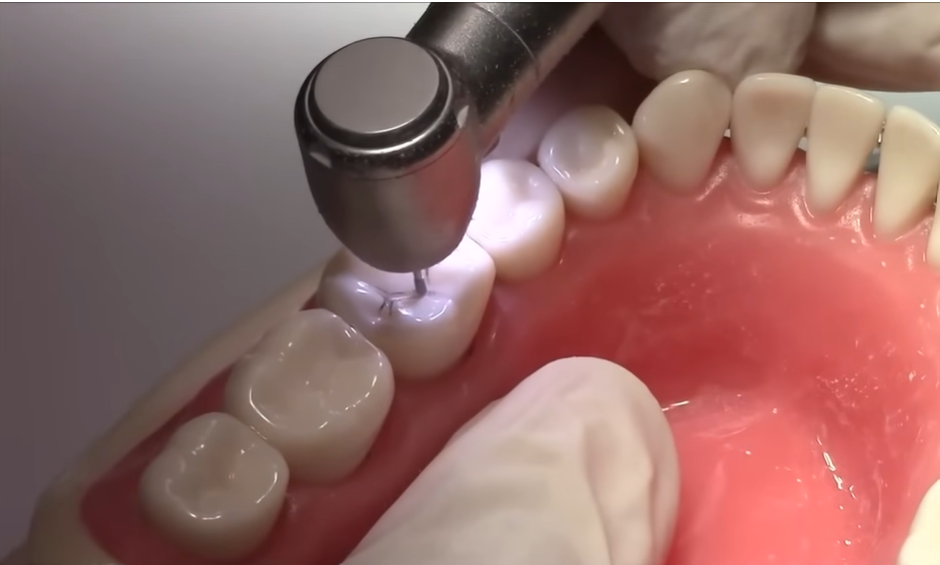 Cavity preparation 