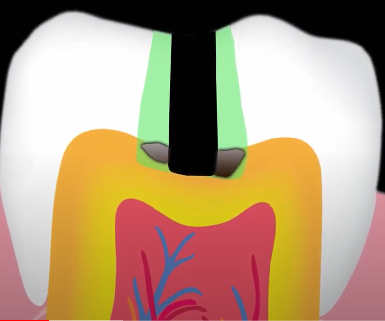 Covenience form in cavity preparation.