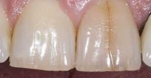 Craze line in treatment of traumatised teeth