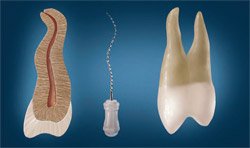 Curved canal in single visit endodontics