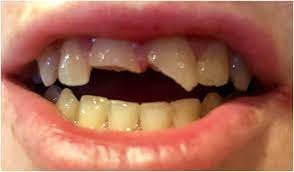 enamel, dentin with exposure to the pulp in treatment of traumatized tooth