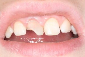 enamel and dentin fracture in treatment of traumatised tooth