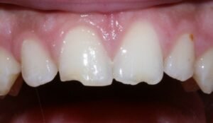 enamel fracture in treatment of traumatised tooth