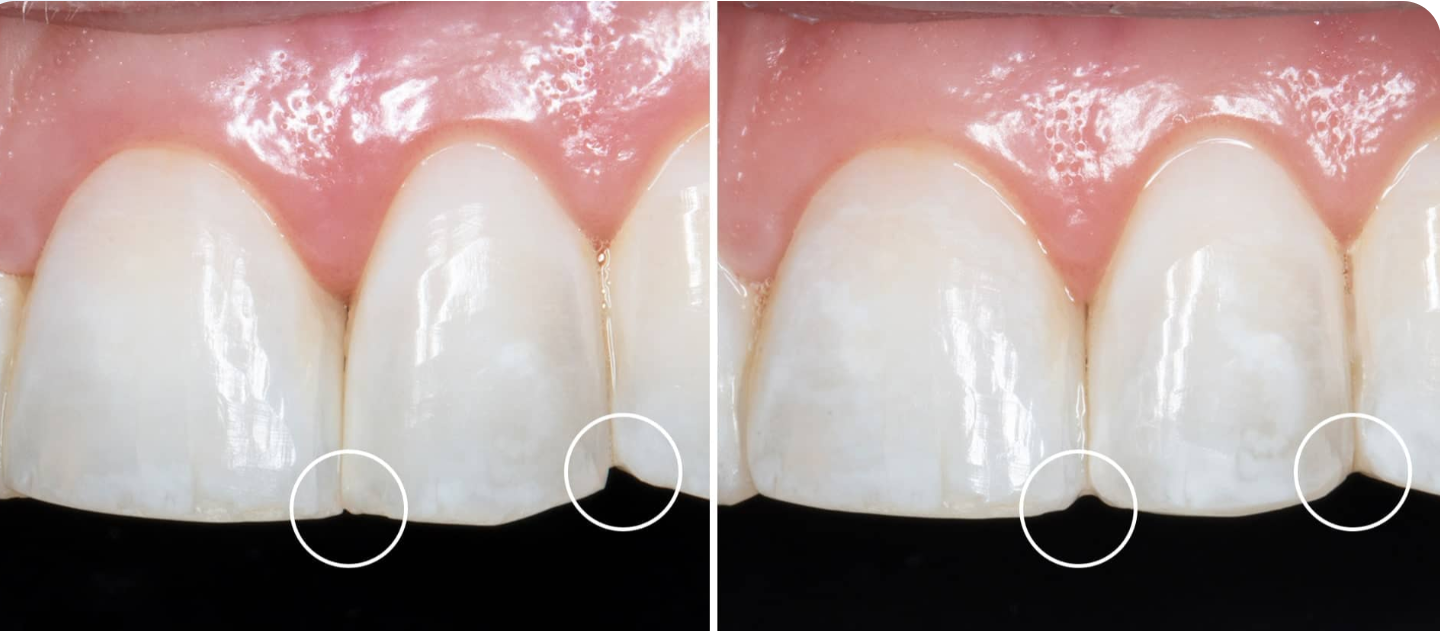 Enameloplasty in cavity preparation.
