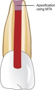 Apexification in Endodontics Image