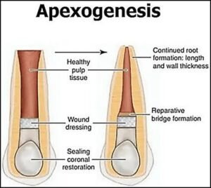 Apexogenesis in Endodontics