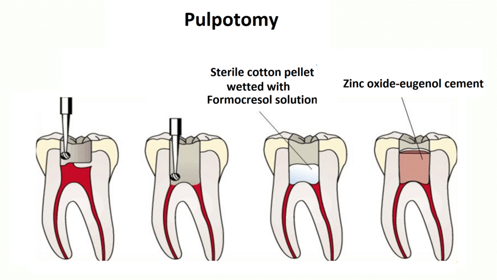Pulpotomy Endodontics Image