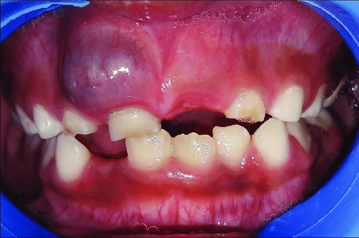 Eruption cyst 