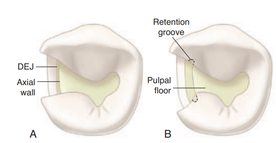 Grooves in cavity preparation.