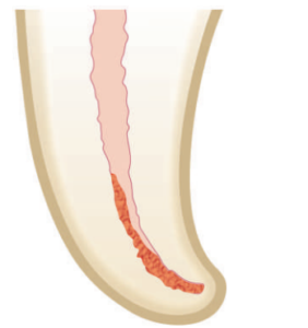 irrigants removing dentin 