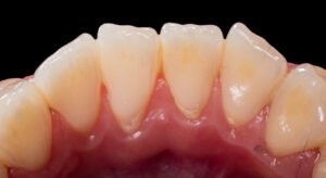 lingual surface in GV black classification