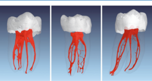 microCT image of tooth in irrigants and intracanal medicaments