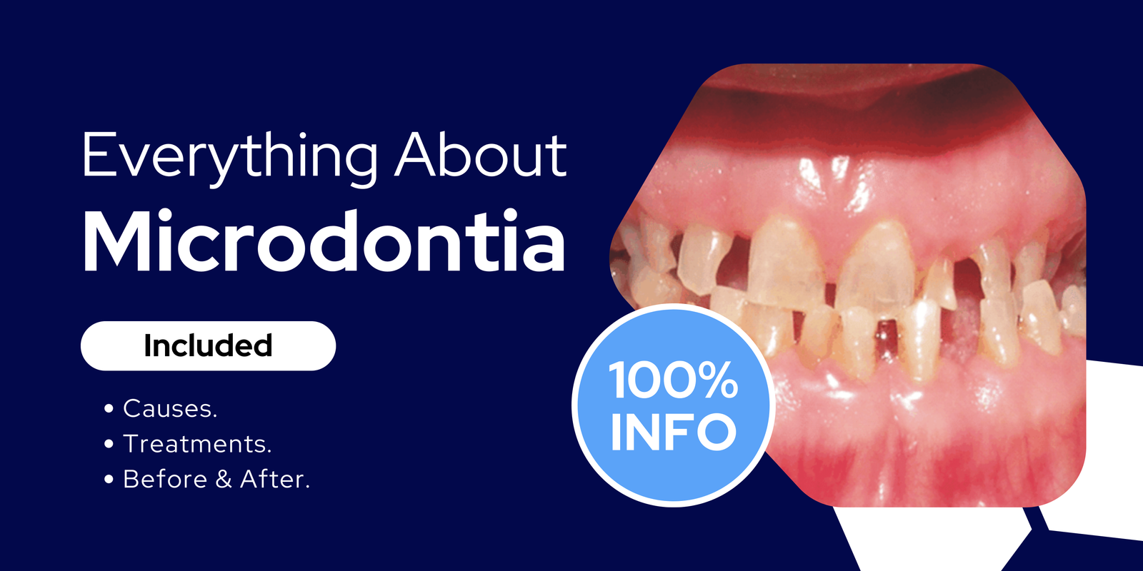 Microdontia in Dentistry