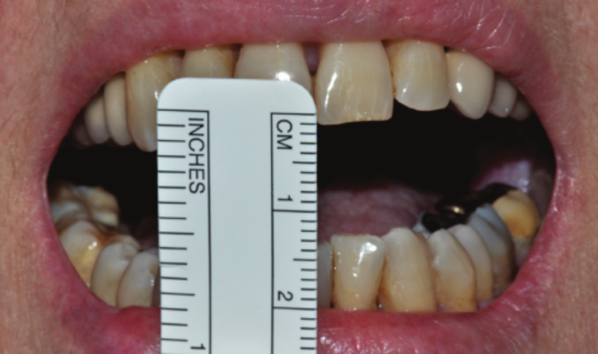 limited mouth opening in single visit endodontics. 