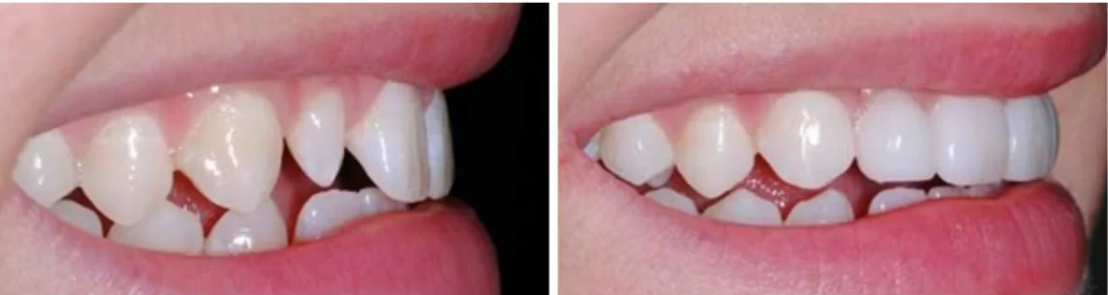 veneer in microdontia.