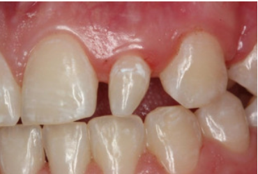 Peg lateral 
