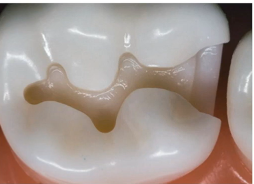 Preserving cuspal strength in cavity preparation.