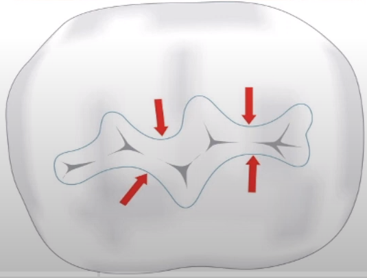 Preserving strength of marginal ridge in cavity preparation.