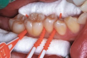 Proximal surface in GV Black classification