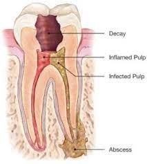 RCT in Endodontics