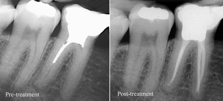 Retreatment in Endodontics