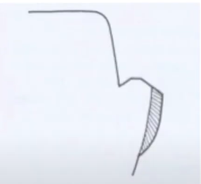 Reverse bevel in cavity preparation.