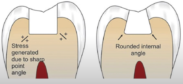 Rounding of line angle in cavity preparation.