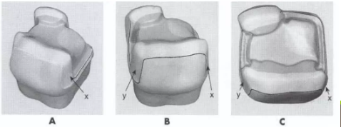 Skirts in cavity preparation.