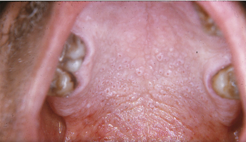 Stomatitis nicotina 