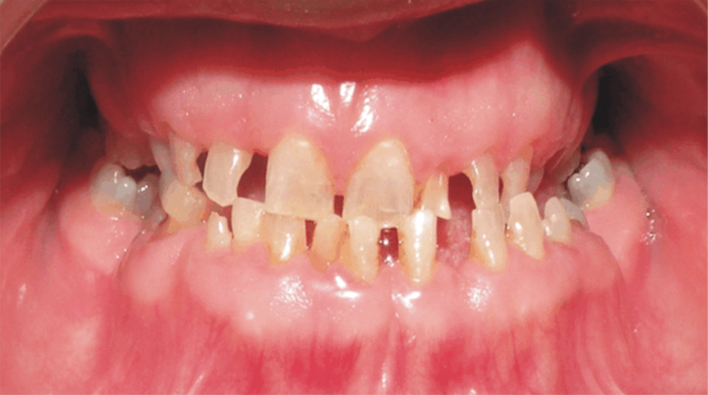 True generalised microdontia.