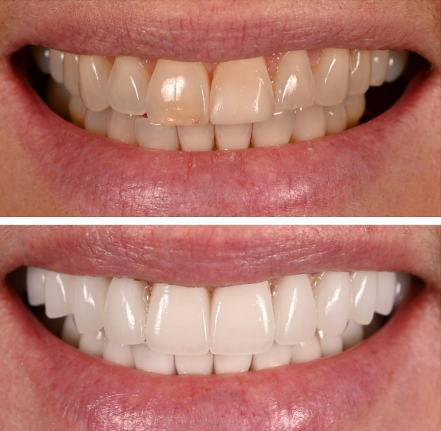 Veneering in Endodontics