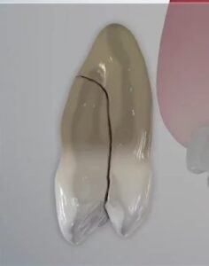 vertical root fracture in treatment of traumatized tooth