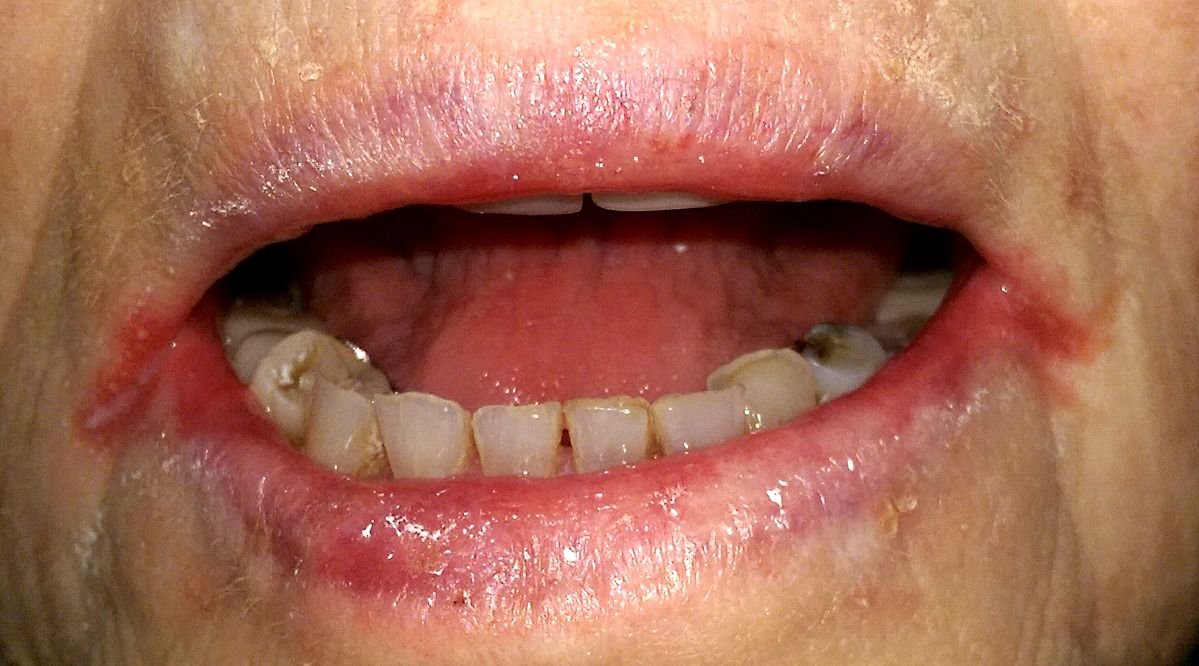 Vitamin B2 deficiency in ANUG.
